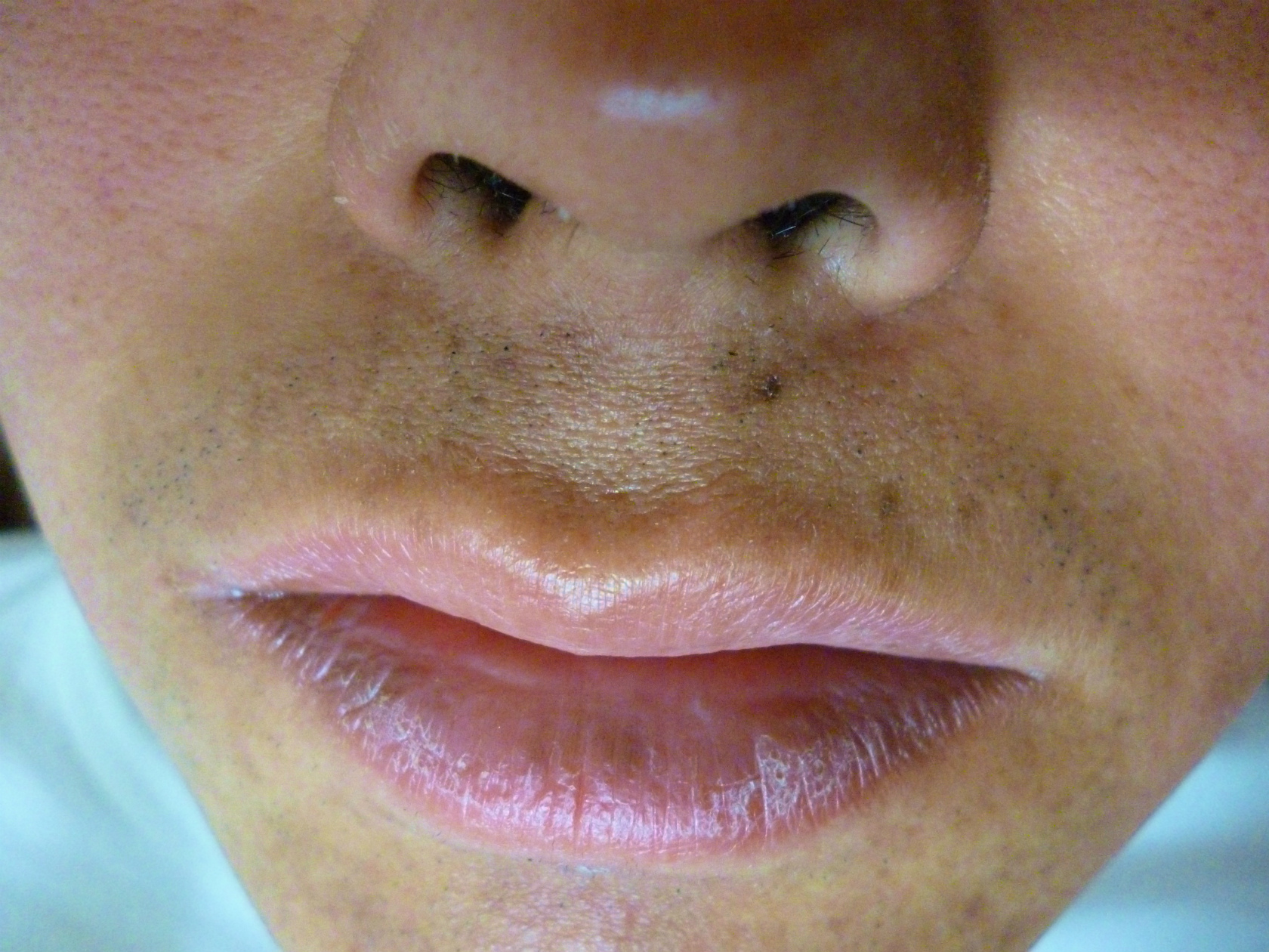 女性 ひげ 鼻の下 黒い 237595女性 ひげ 鼻の下 黒い Blogjpmbahekecw