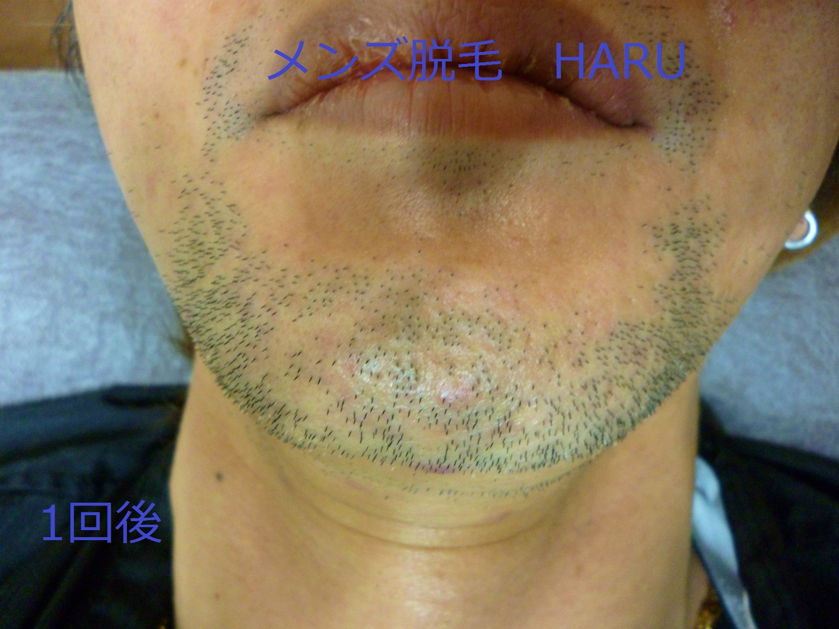 ヒゲ脱毛（アゴ）7回後の症例写真 39歳 男性 愛知県津島市在住 名古屋メンズ脱毛・ヒゲ脱毛HARU