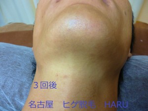 HARUP1060171