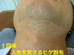 ヒゲ脱毛　首１回後