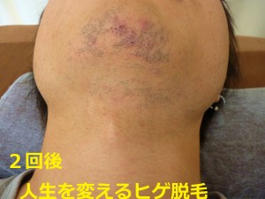 ヒゲ脱毛　首２回後