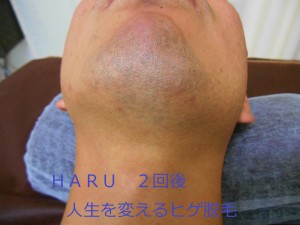 名古屋ヒゲ脱毛ＨＡＲＵ首2