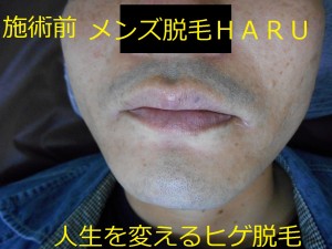 ヒゲ脱毛施術前