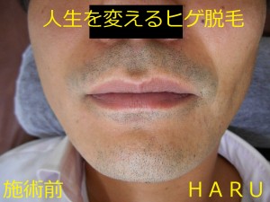 ヒゲ脱毛　施術前