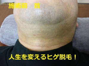 ヒゲ脱毛首施術前