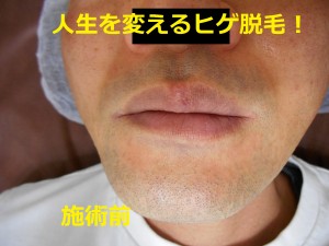 ヒゲ脱毛　施術前