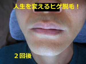 ヒゲ脱毛　２回後