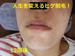 ヒゲ脱毛　12回後