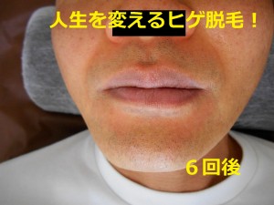 ヒゲ脱毛　６回後