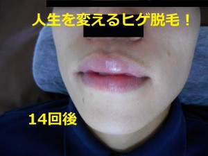 ヒゲ脱毛　14回後