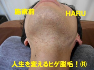 ヒゲ脱毛　首　施術前