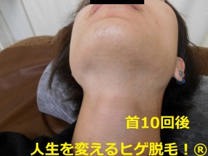 ヒゲ脱毛　首10回後