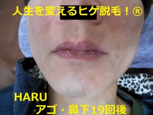 ヒゲ脱毛　アゴ・鼻下　19回後