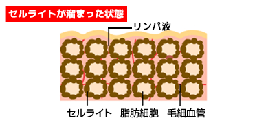 セルライトが溜まった状態