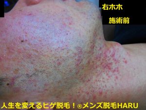 永久脱毛への道 続カミソリ負けが治った編 名古屋メンズ脱毛 ヒゲ脱毛haru