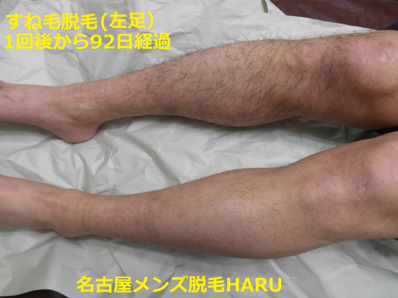 すね毛脱毛をお考えの方は今すぐご確認ください 名古屋栄メンズ脱毛 ヒゲ脱毛haru