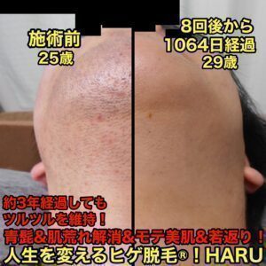 ヒゲ脱毛（首）8回後から1064日経過　【名古屋 栄のメンズ脱毛 プライベートサロン ハル(Private Salon Haru)】