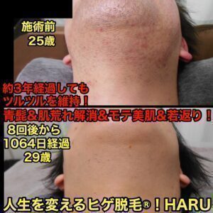 ヒゲ脱毛（首）8回後から1064日経過　【名古屋 栄のメンズ脱毛 プライベートサロン ハル(Private Salon Haru)】