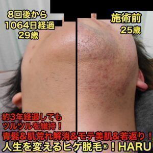 ヒゲ脱毛（首）8回後から1064日経過　【名古屋 栄のメンズ脱毛 プライベートサロン ハル(Private Salon Haru)】